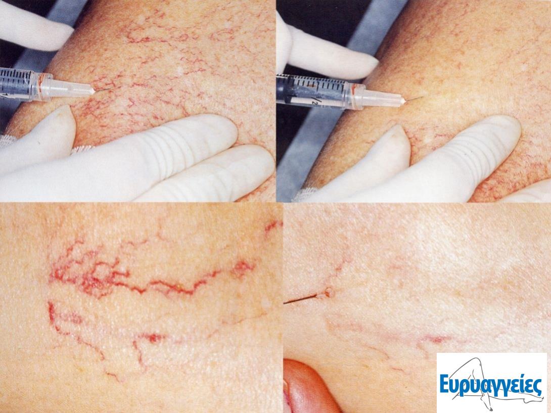 Sclerotherapy procedure2